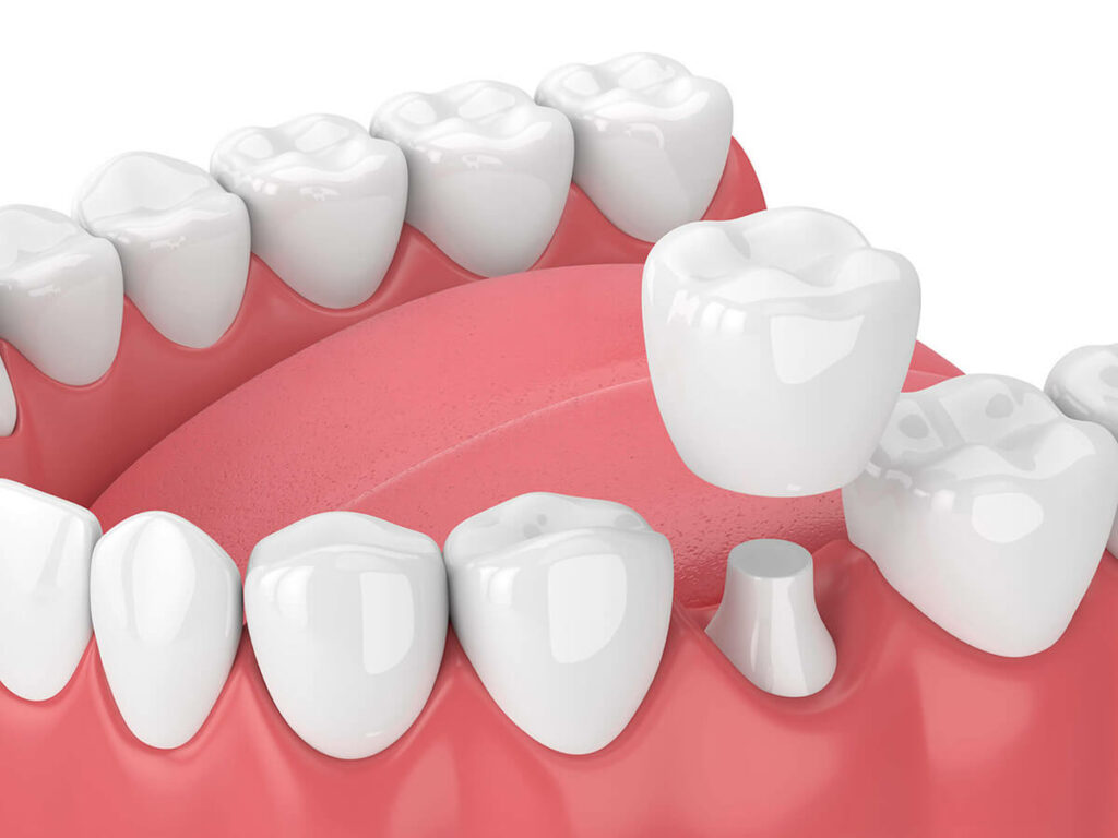 graphic of a crown being placed on a tooth