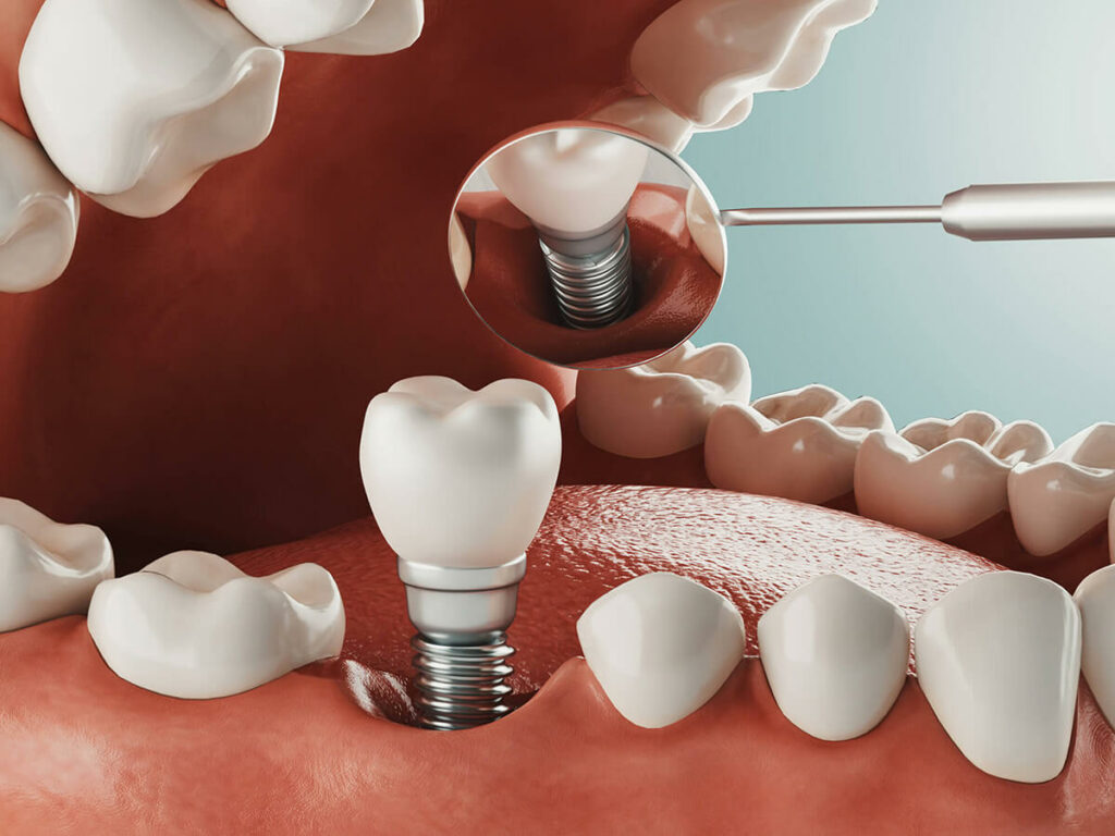 graphic of a dental implant being placed in the jaw