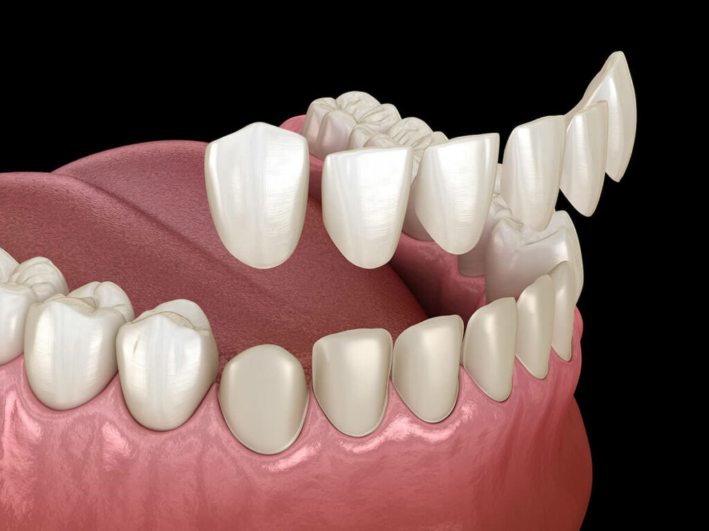 graphic of dental veneers being placed ont the bottom row of teeth