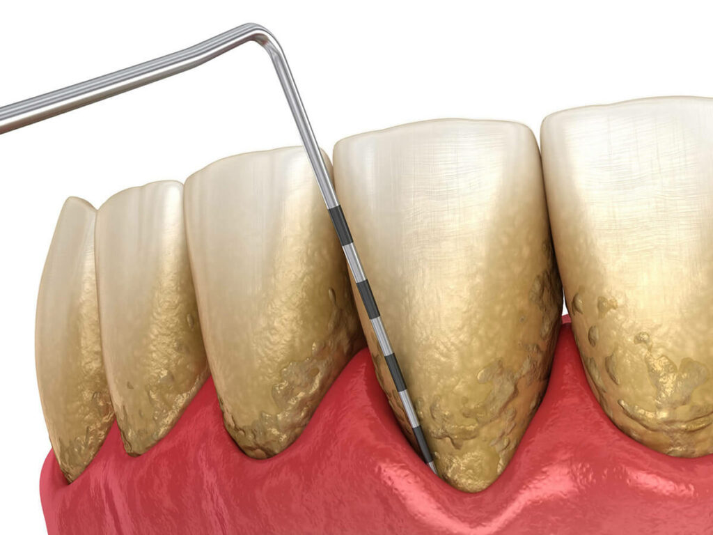 graphic of gums being measured