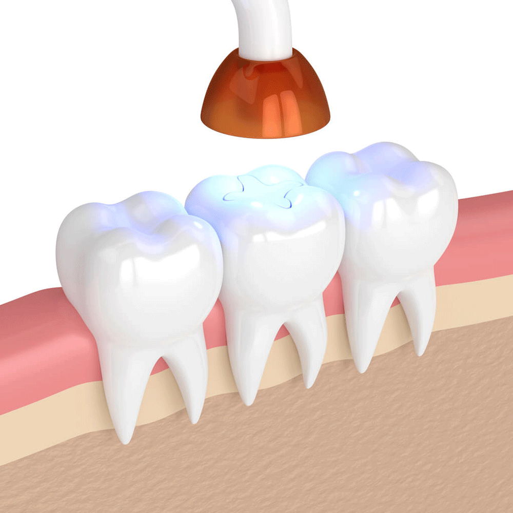 graphic of model teeth with a filling placed