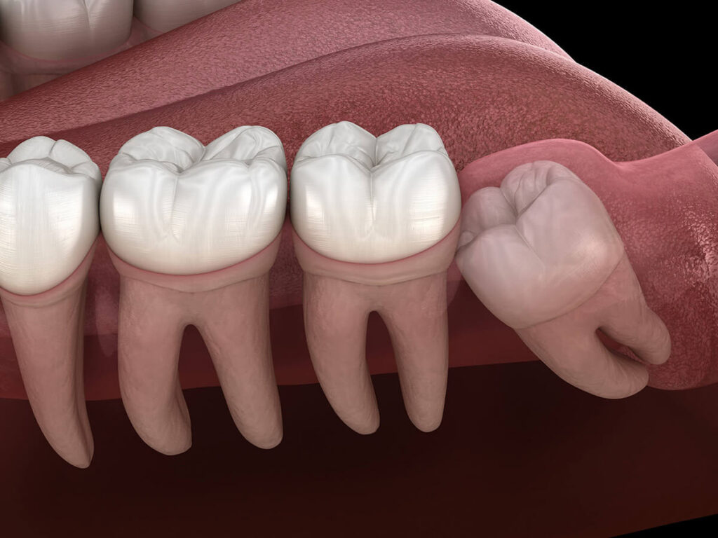 Image of an impacted wisdom tooth